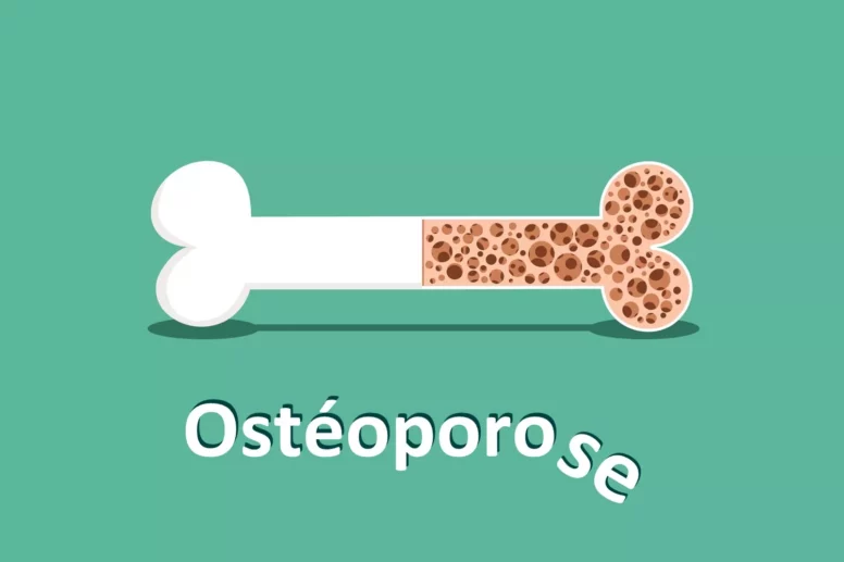 Comment prévenir l’ostéoporose